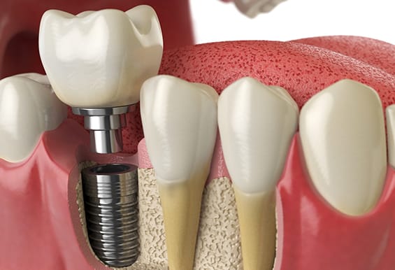 Best-Single-Tooth-dental-Implant-New-Delhi