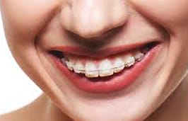 Ceramic-Braces-Citylife-Dental