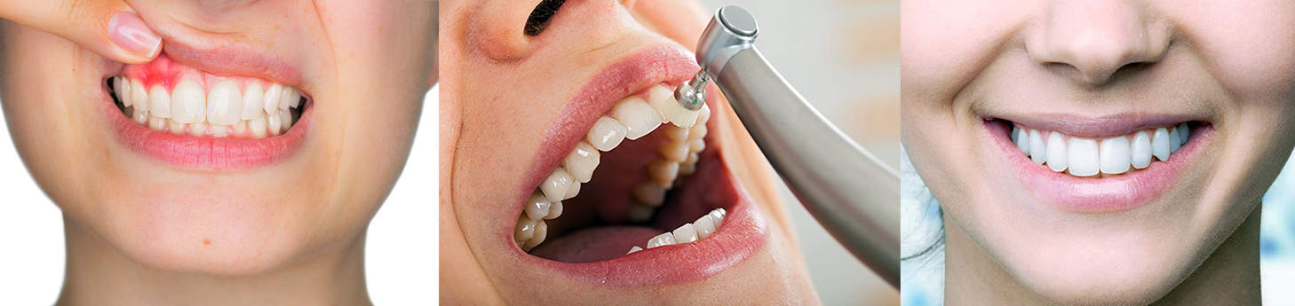 Dental-scaling-Root-planing-New-Denhi-Best-Dentist