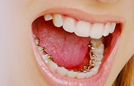 Lingual-braces-Citylife-Dental