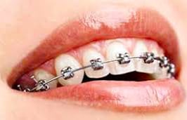 Metal-Braces-Citylife-Dental