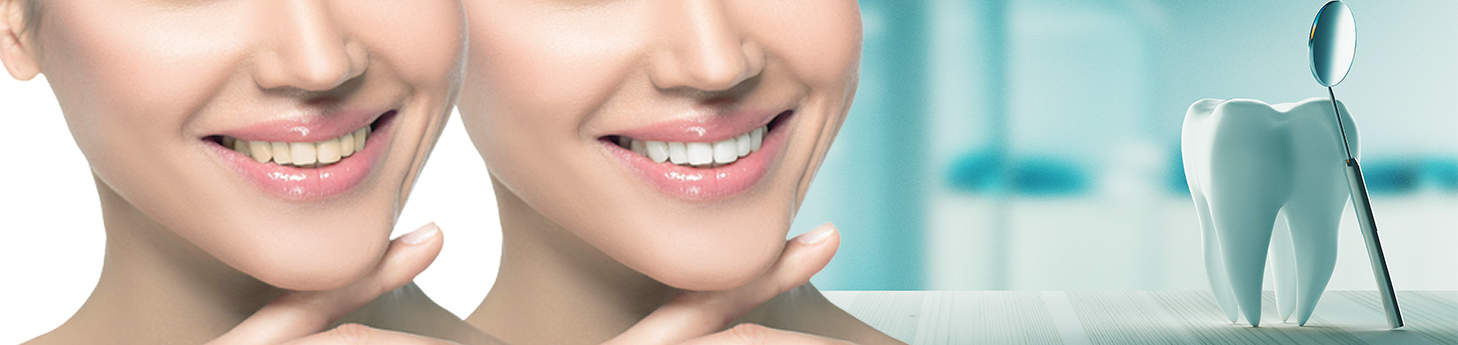 Teeth-Whitening-bleaching