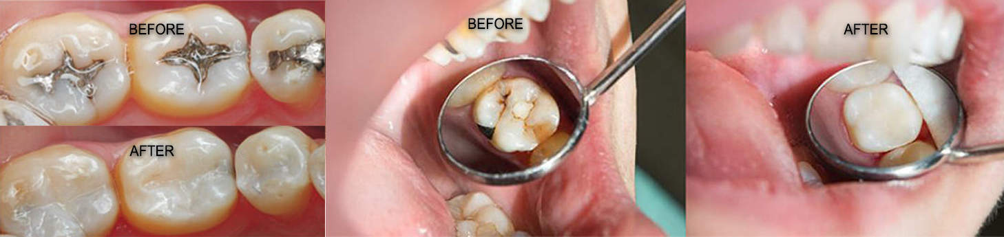 Cosmetic-Dental-Tooth-Fillings