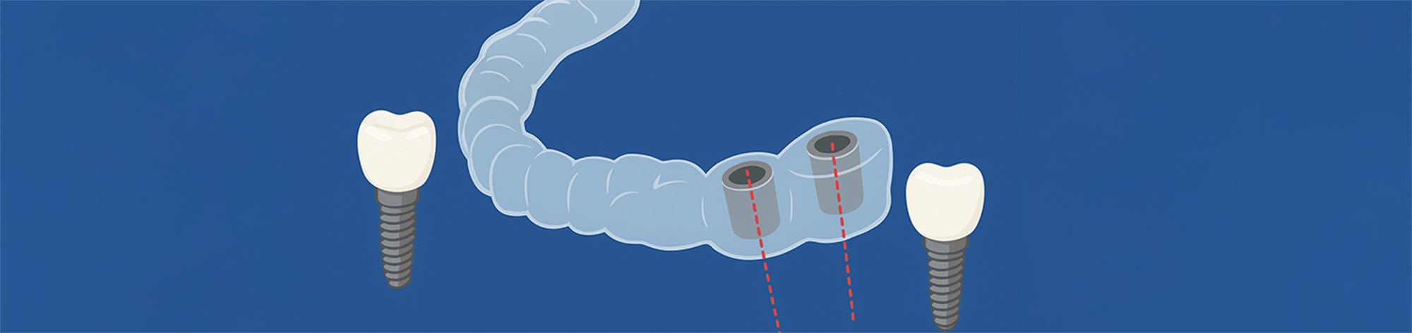 Implant Surgical Guide Planning
