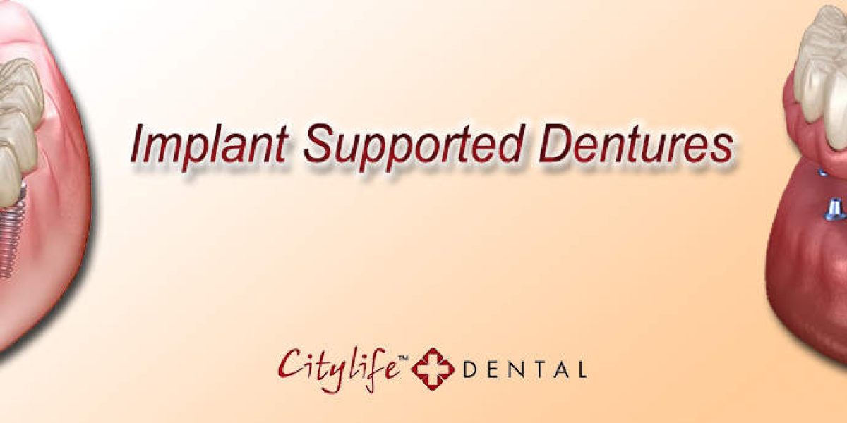 Implant-Support-Dentures
